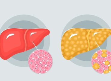Treating Fatty Liver Disease with Diet