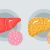 Treating Fatty Liver Disease with Diet