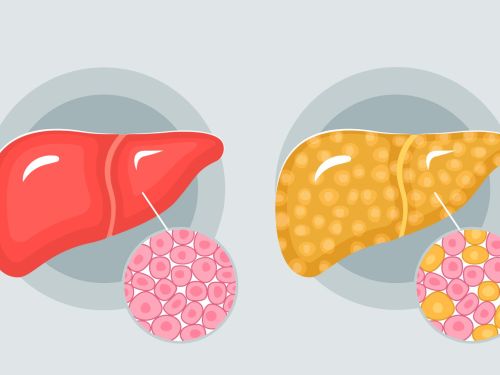 Treating Fatty Liver Disease with Diet